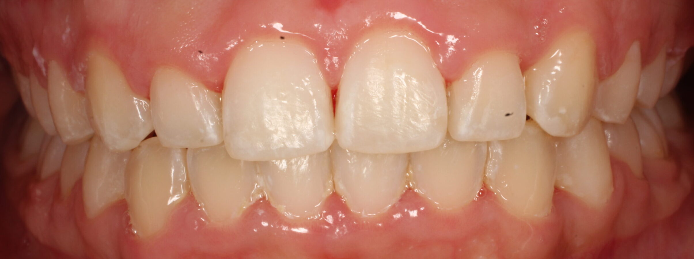 After braces front teeth