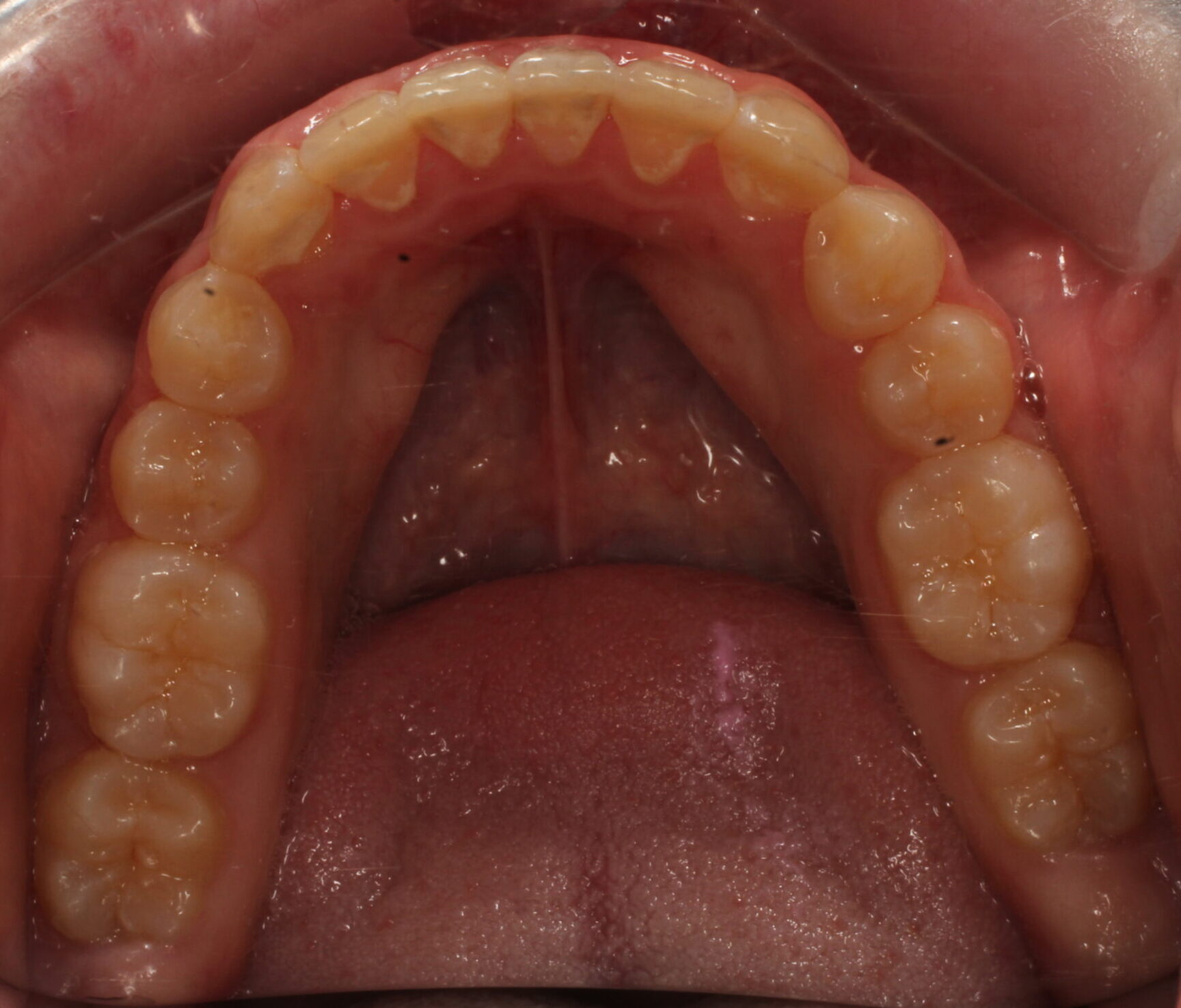 After braces lower teeth
