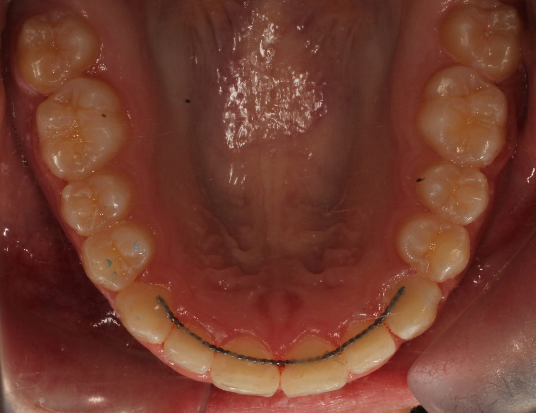 After braces upper teeth