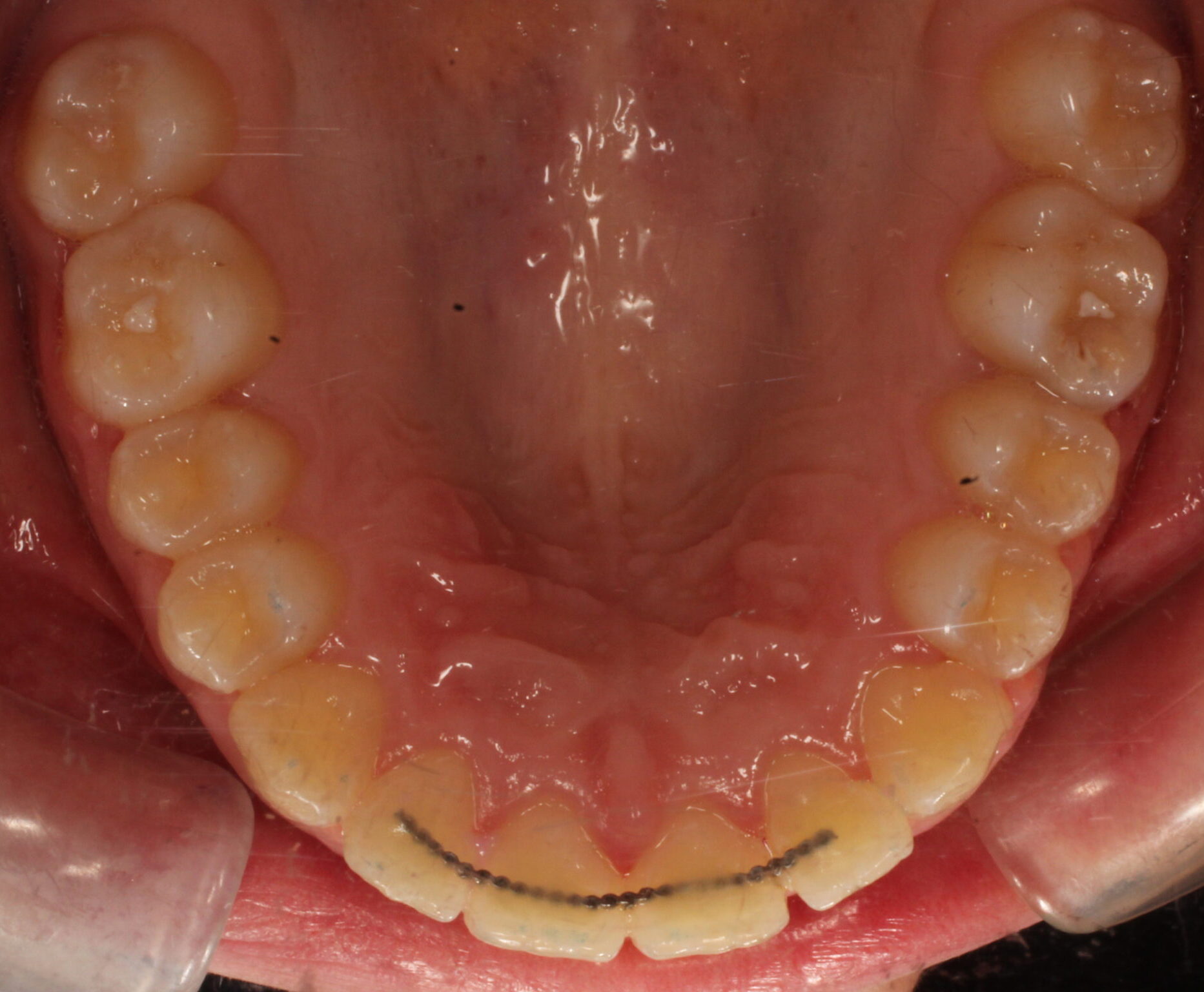 After braces upper teeth
