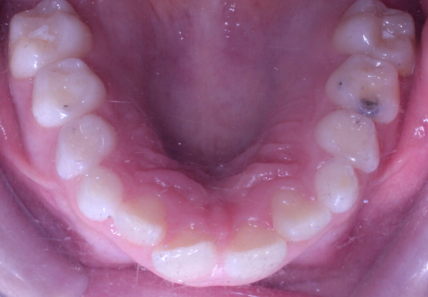Before braces upper teeth