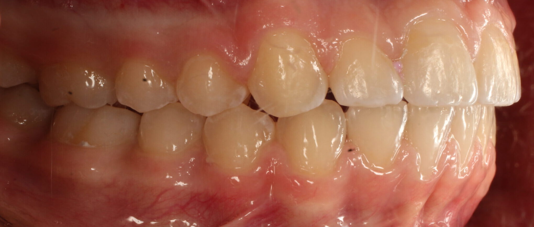 After braces right teeth