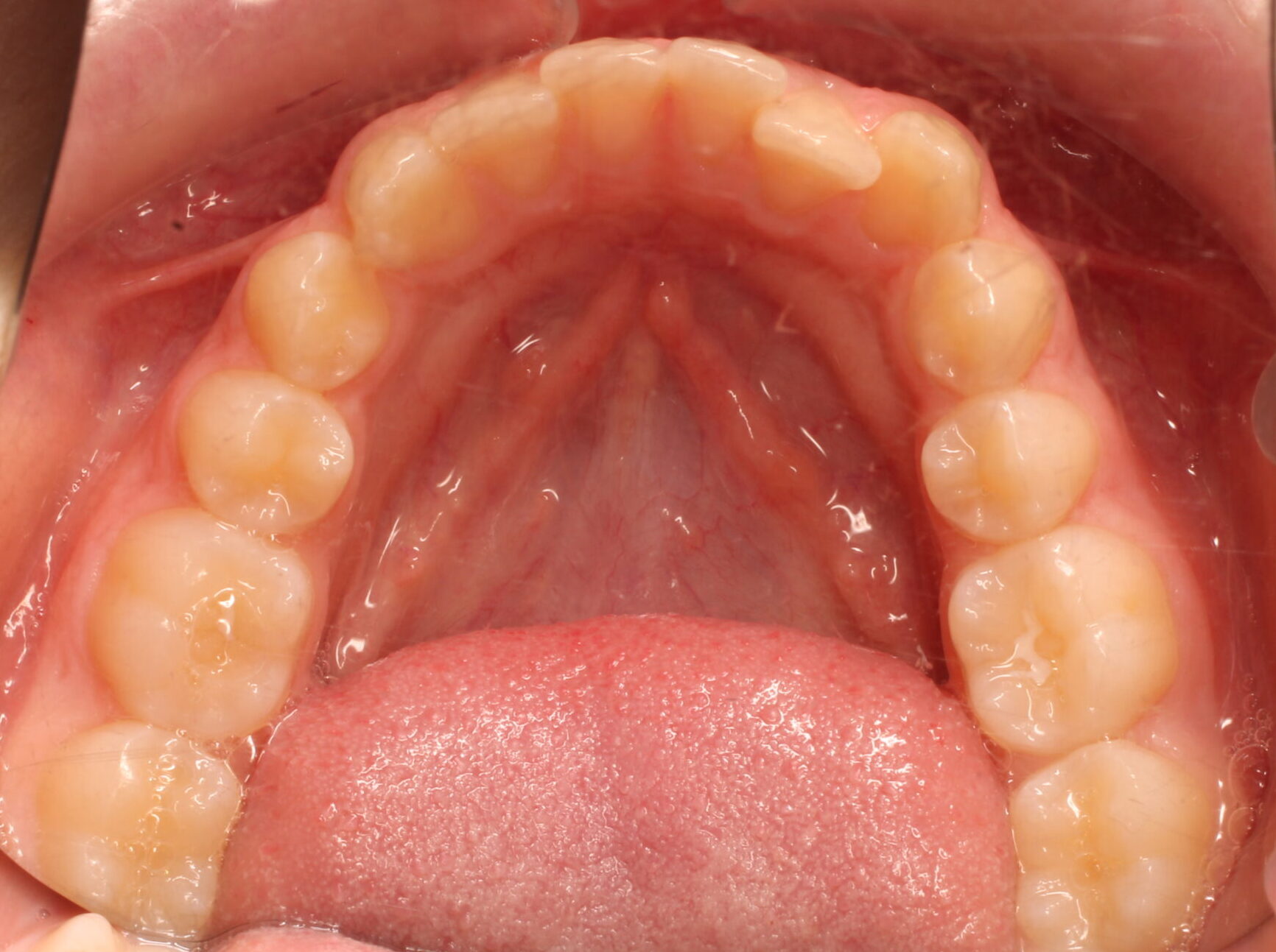 Before braces lower teeth