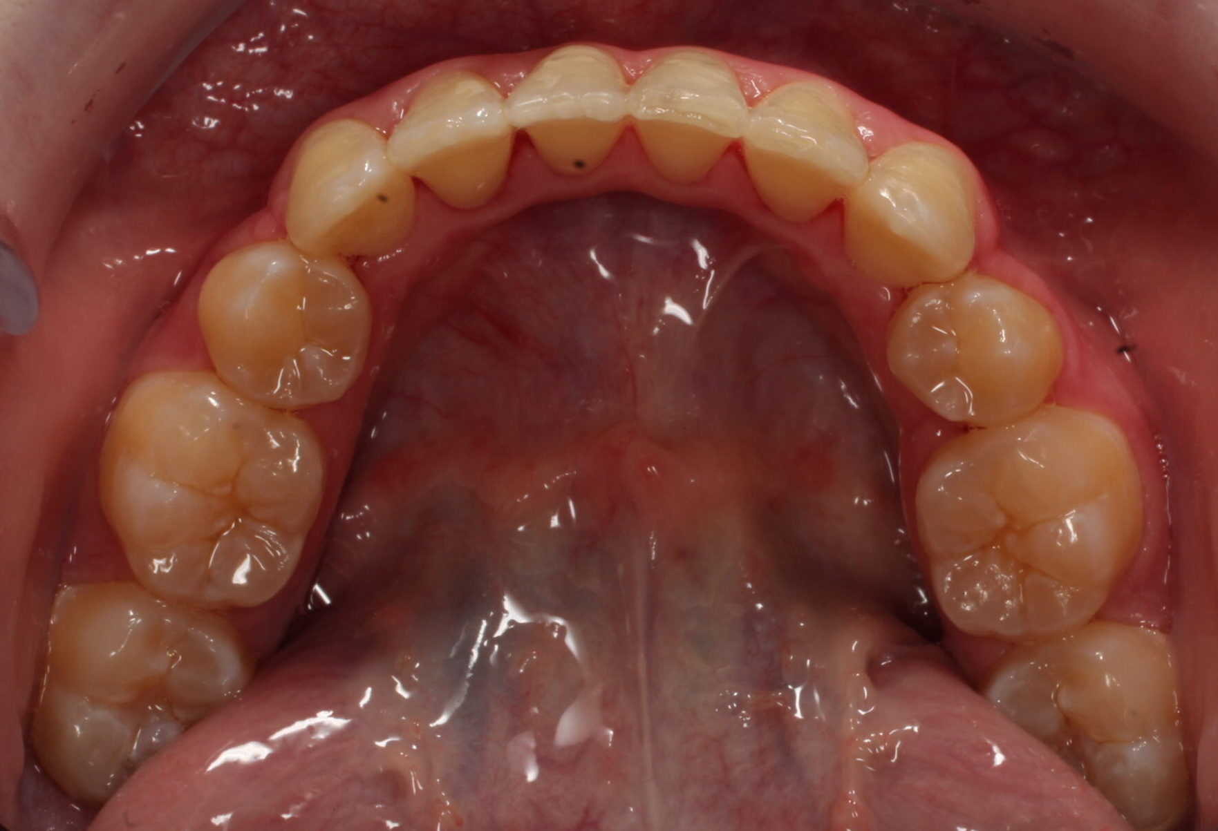 After braces lower teeth