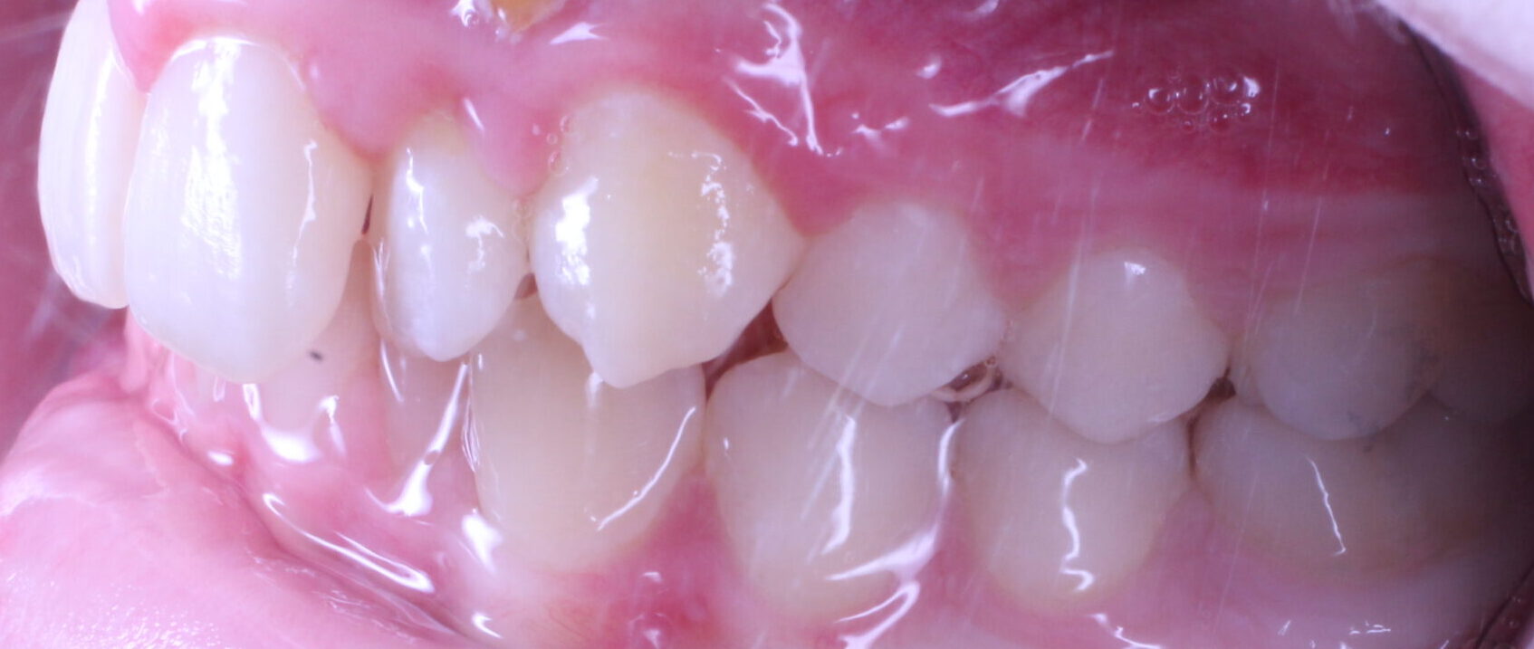 Before braces left teeth