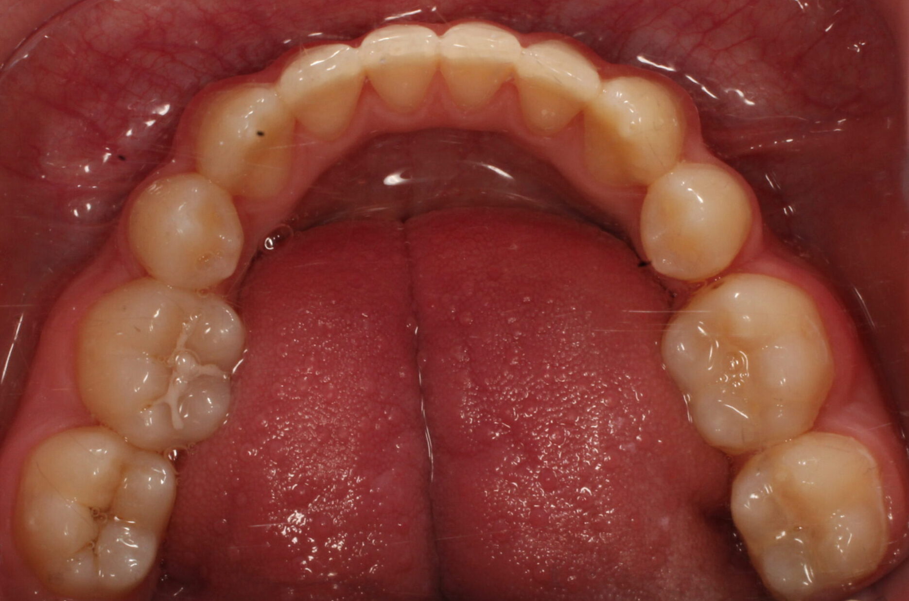 After braces lower teeth