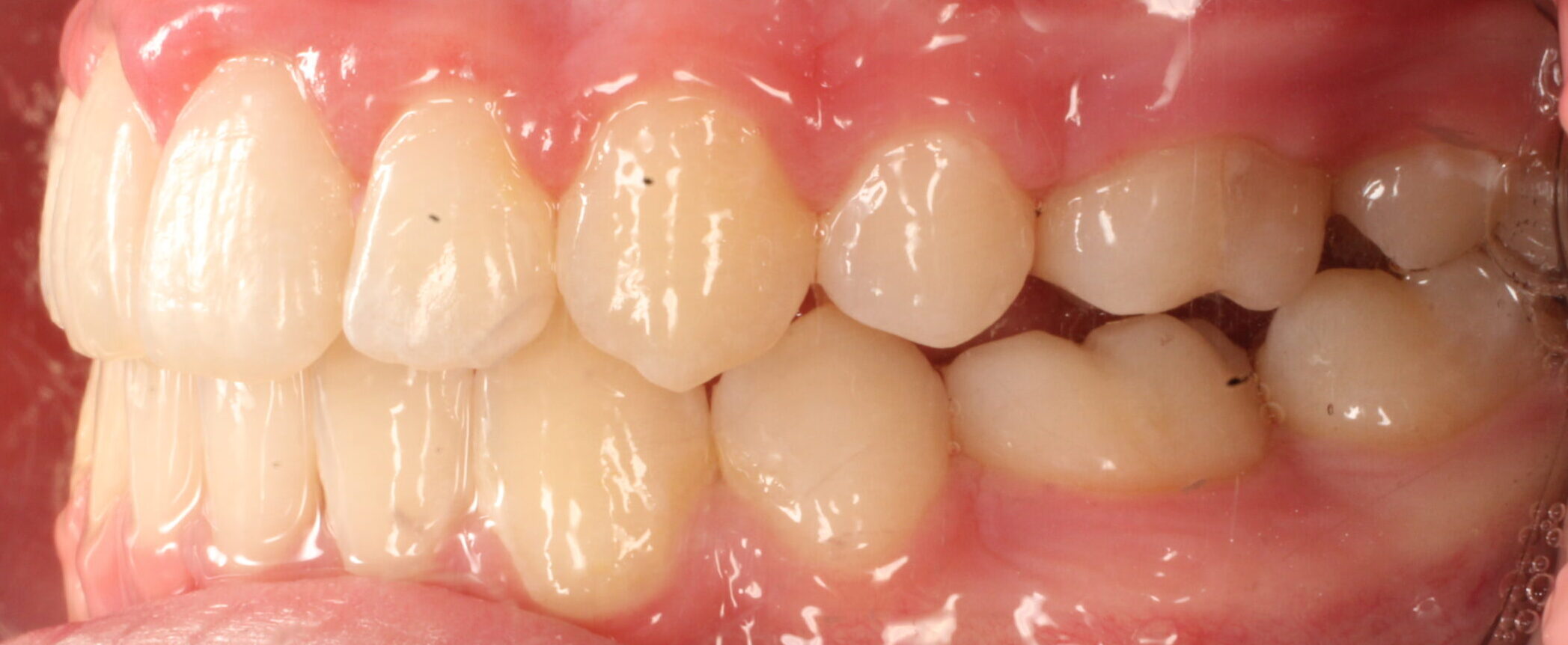 After braces left teeth