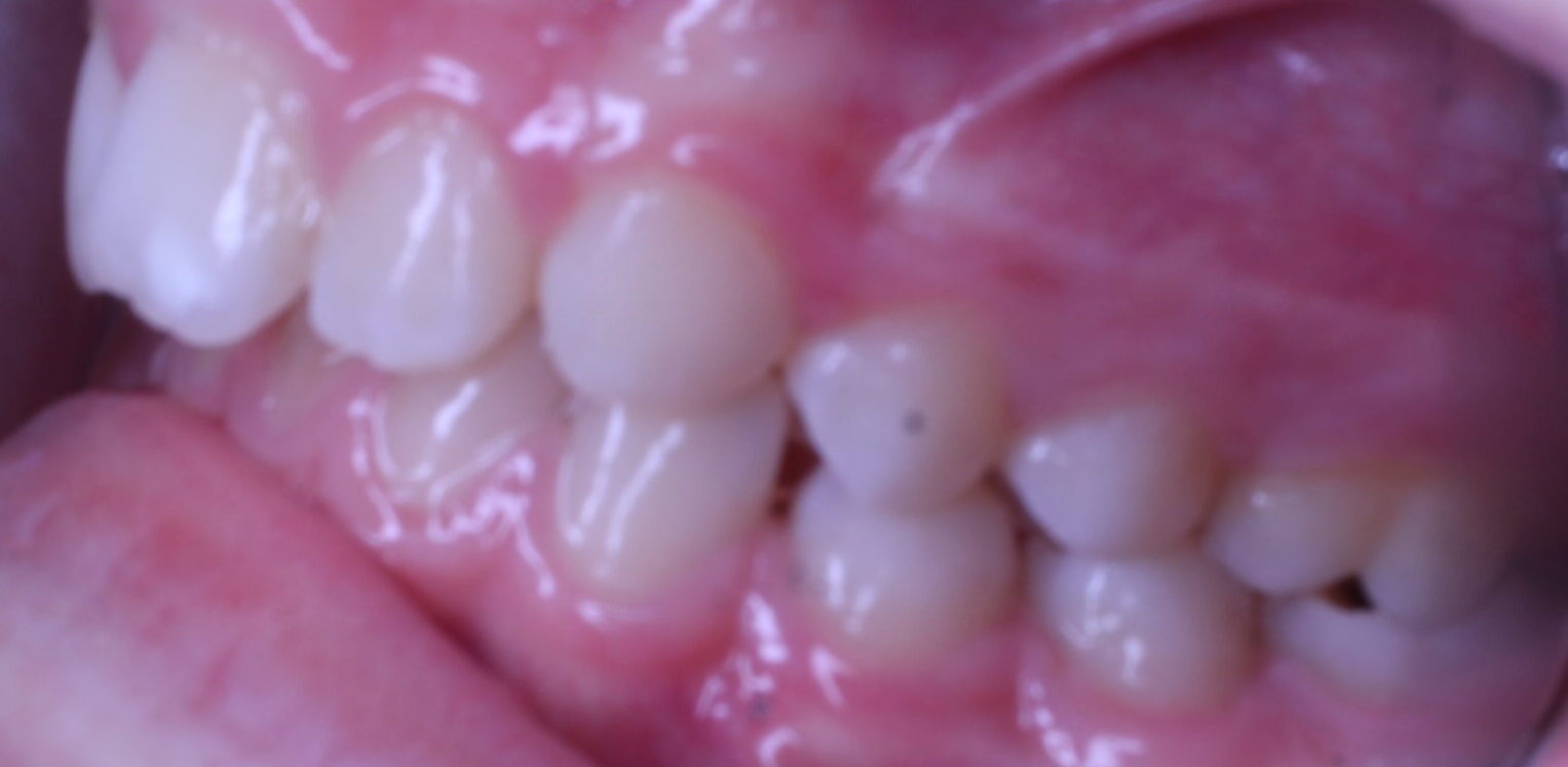 Before braces left teeth