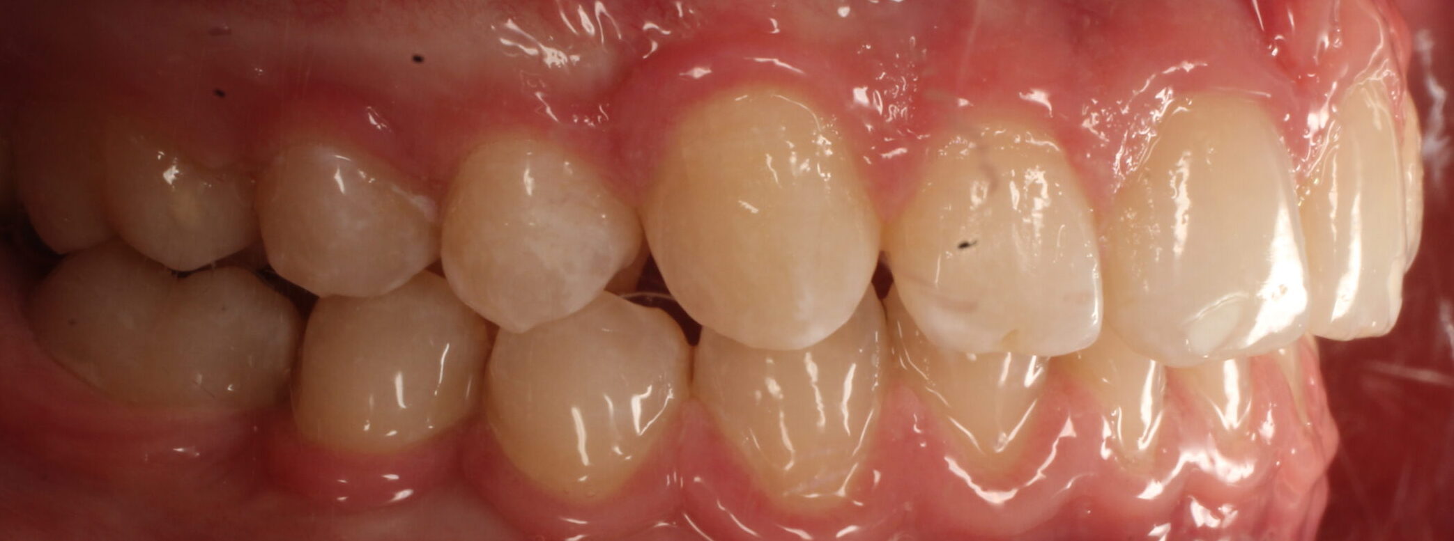 After braces right teeth