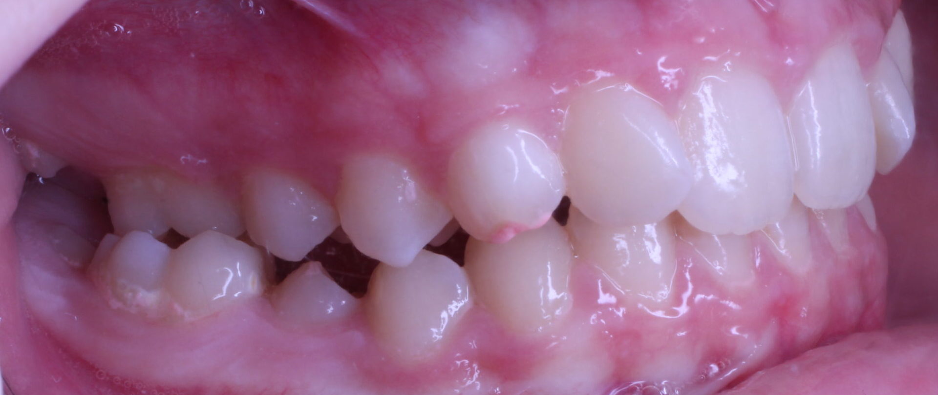 Before braces right teeth