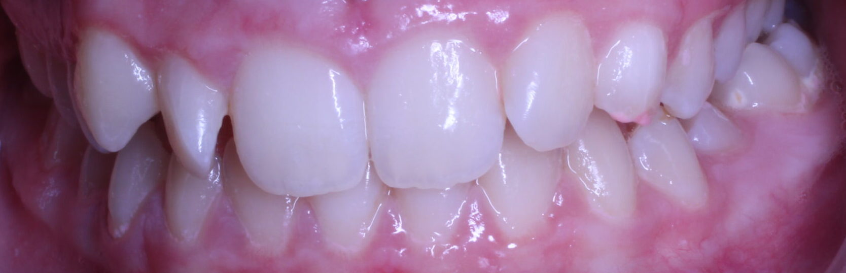 Before braces front teeth