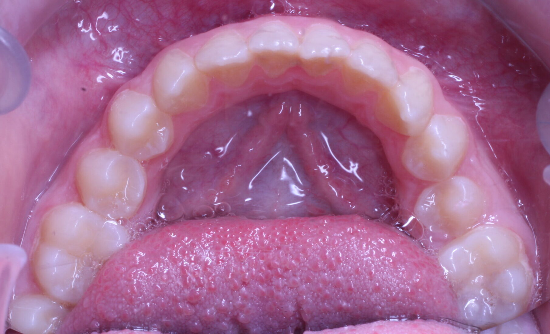 Before braces lower teeth
