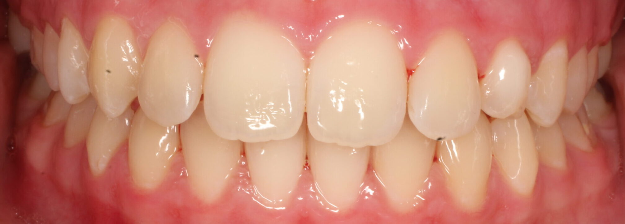 After braces front teeth