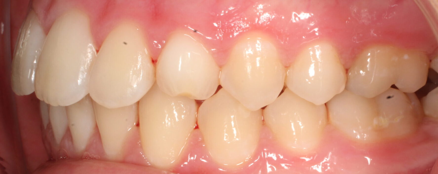 After braces left teeth
