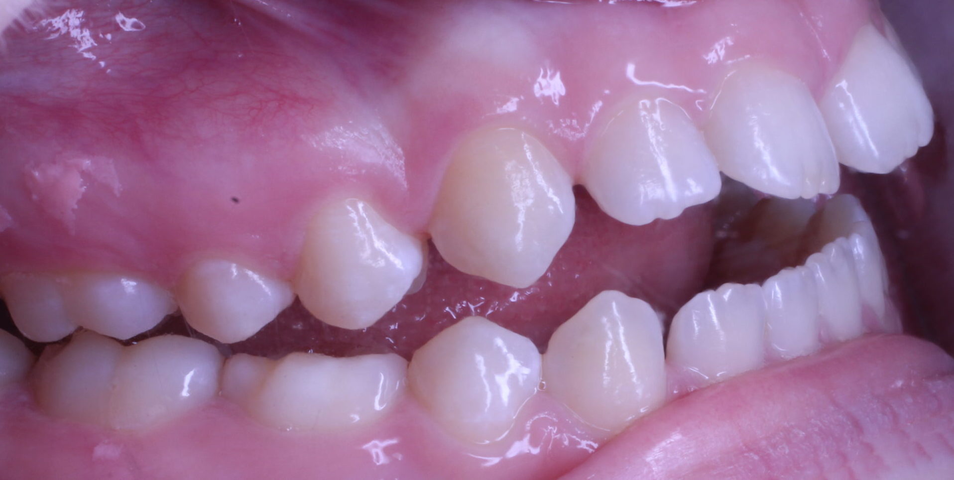 Before braces right teeth