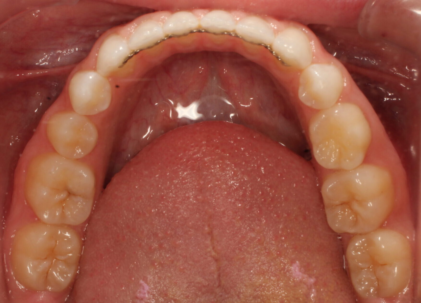 After braces lower teeth