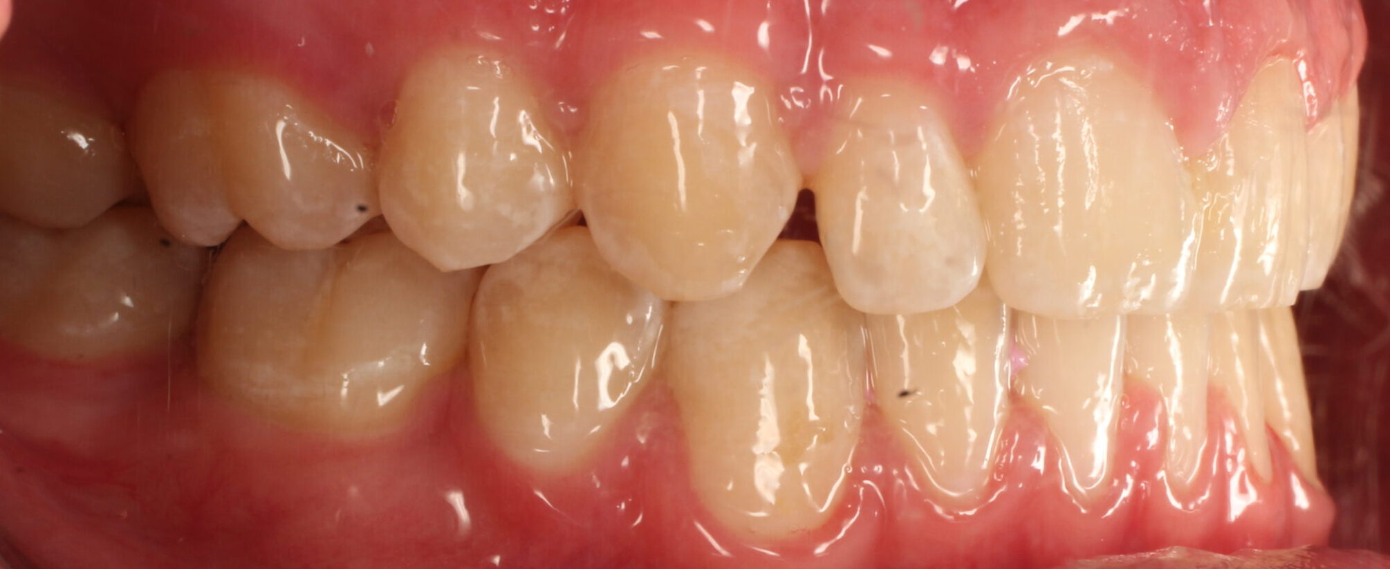 After braces right teeth