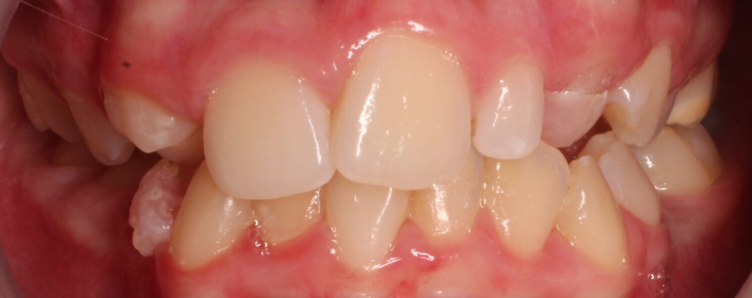Before braces front teeth