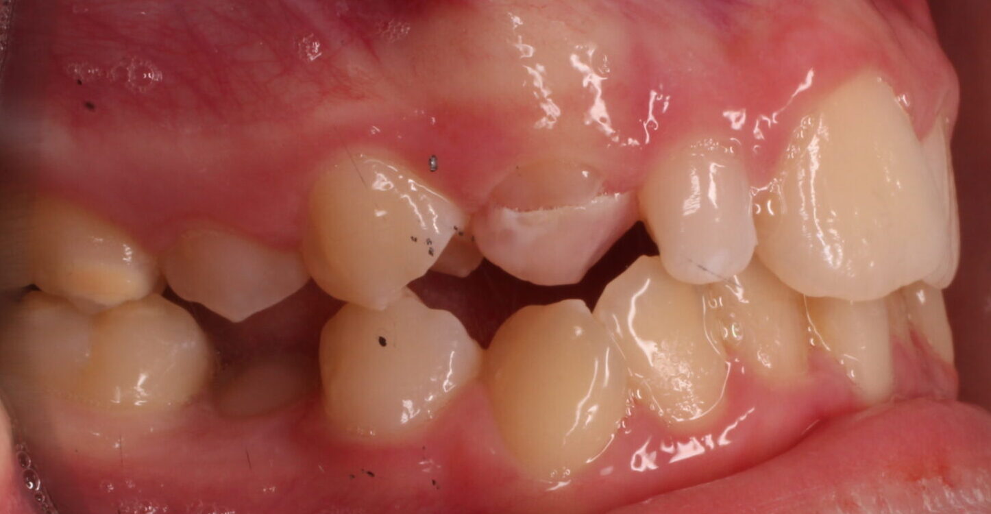 Before braces right teeth