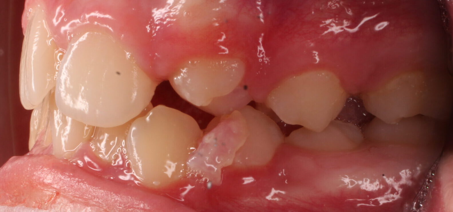 Before braces left teeth