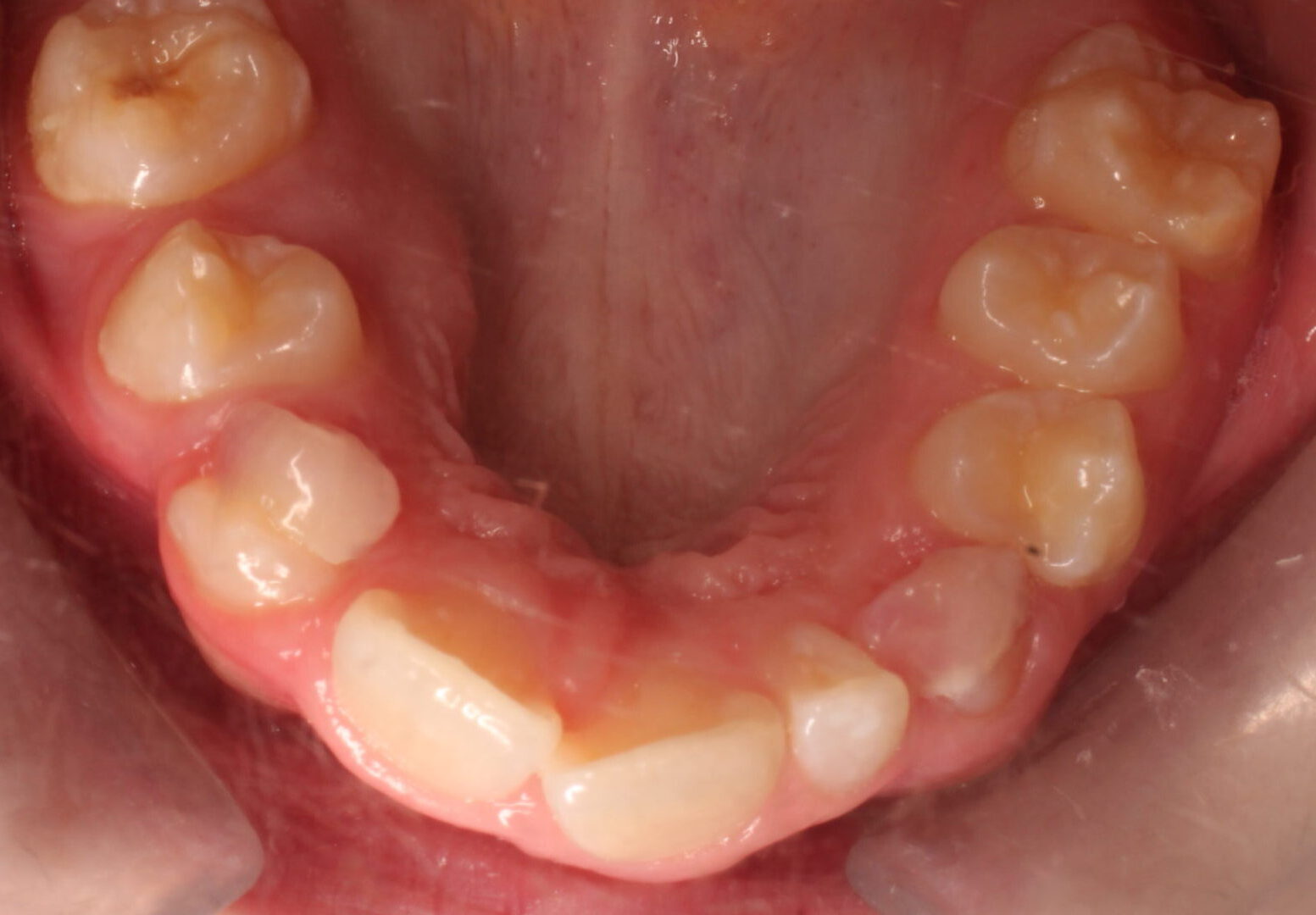 Before braces upper teeth