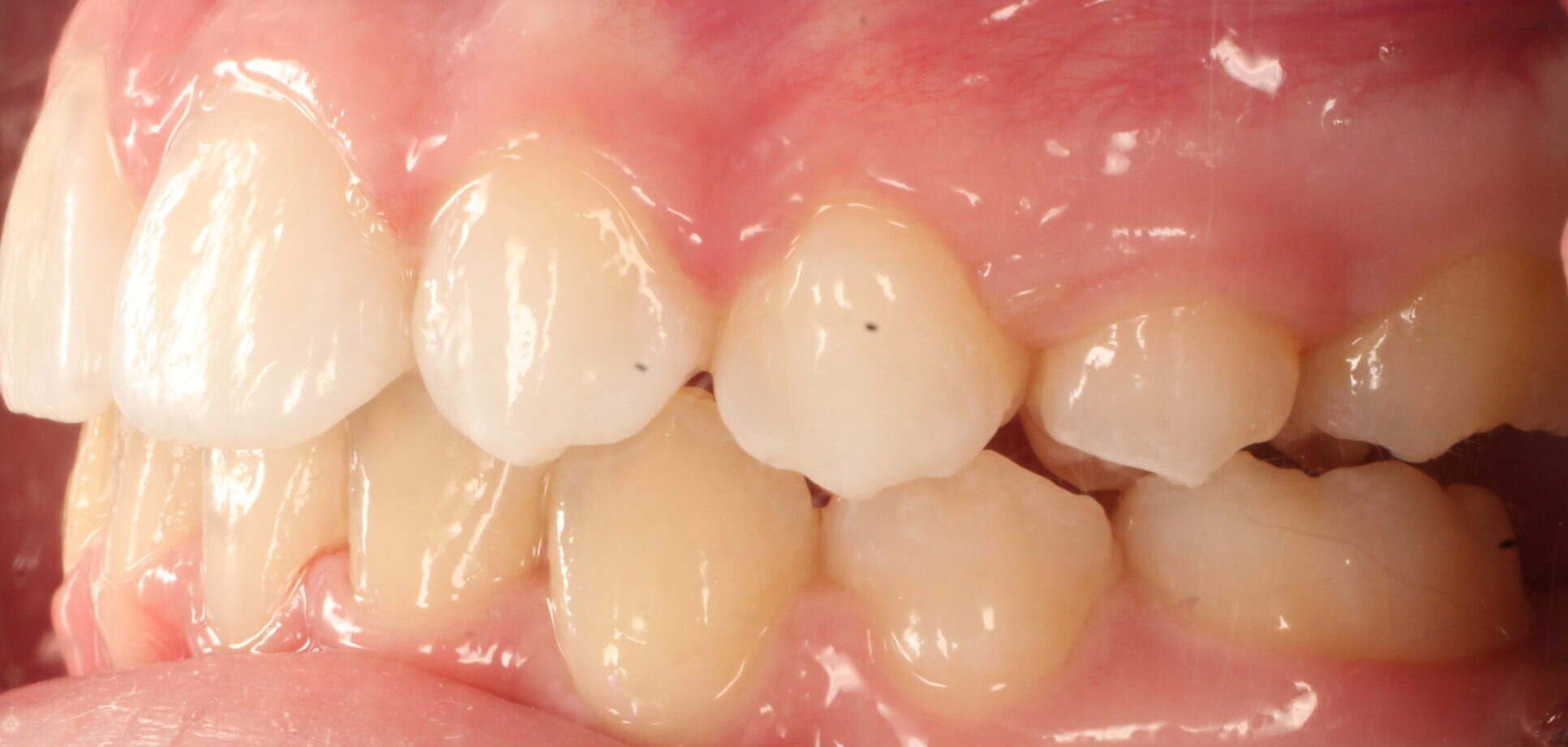 After braces left teeth