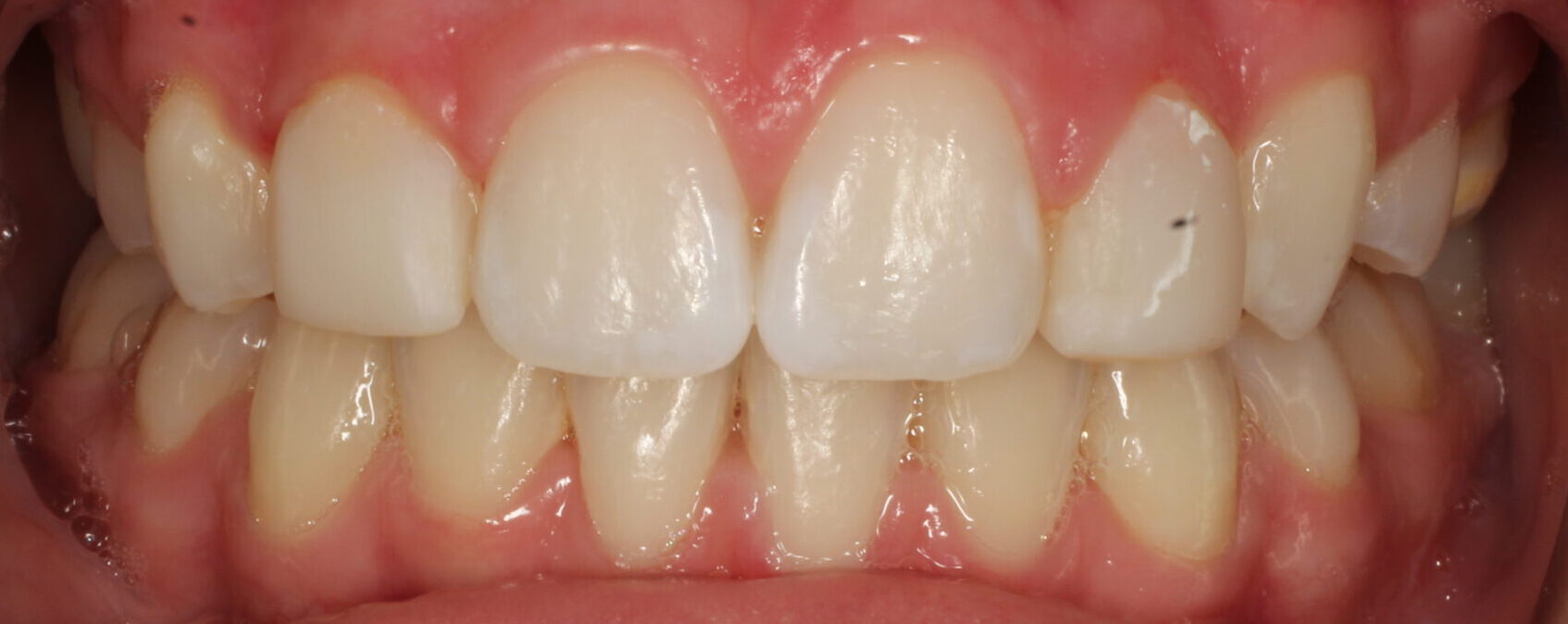 After braces front teeth