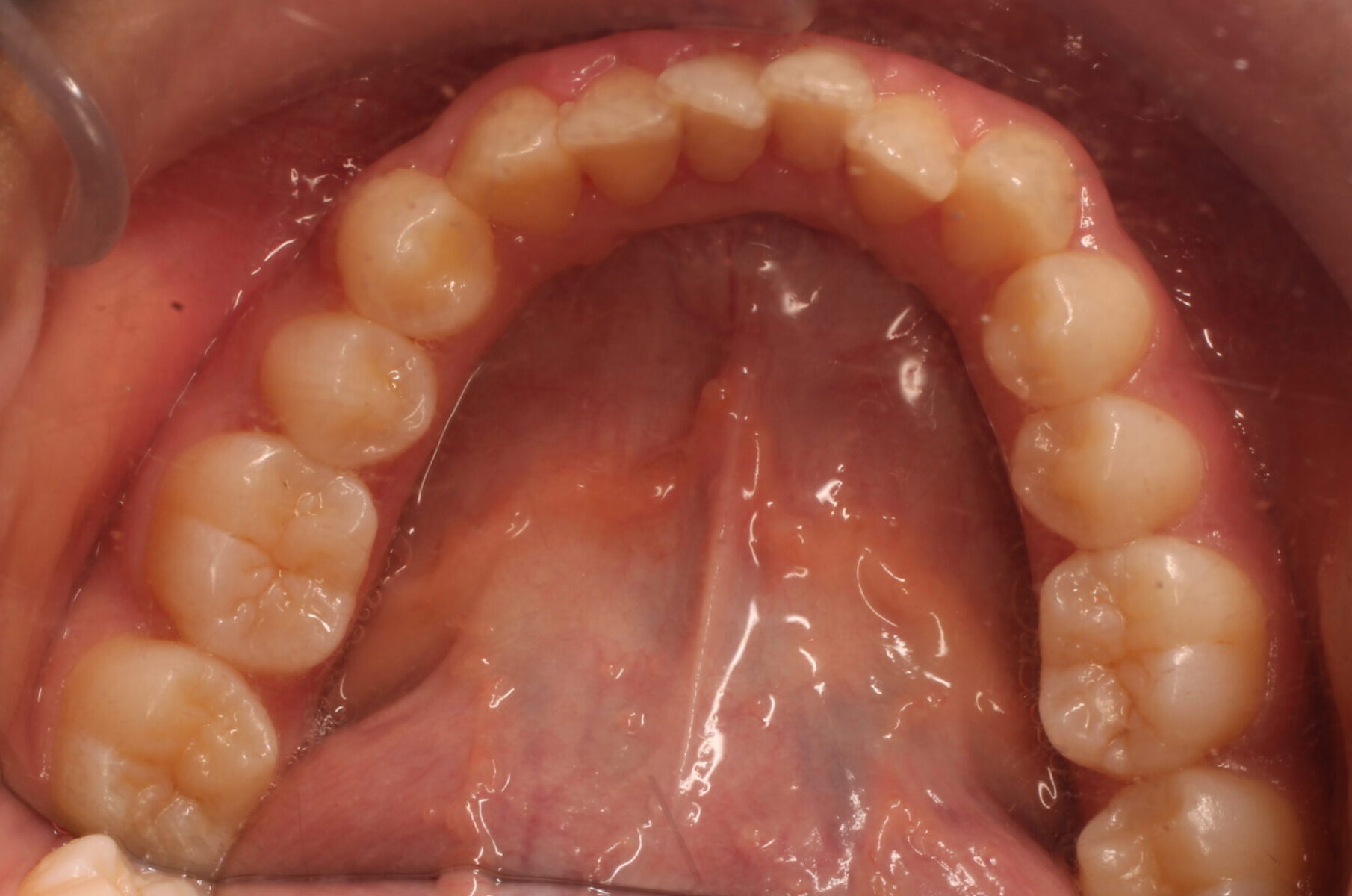 Before braces lower teeth