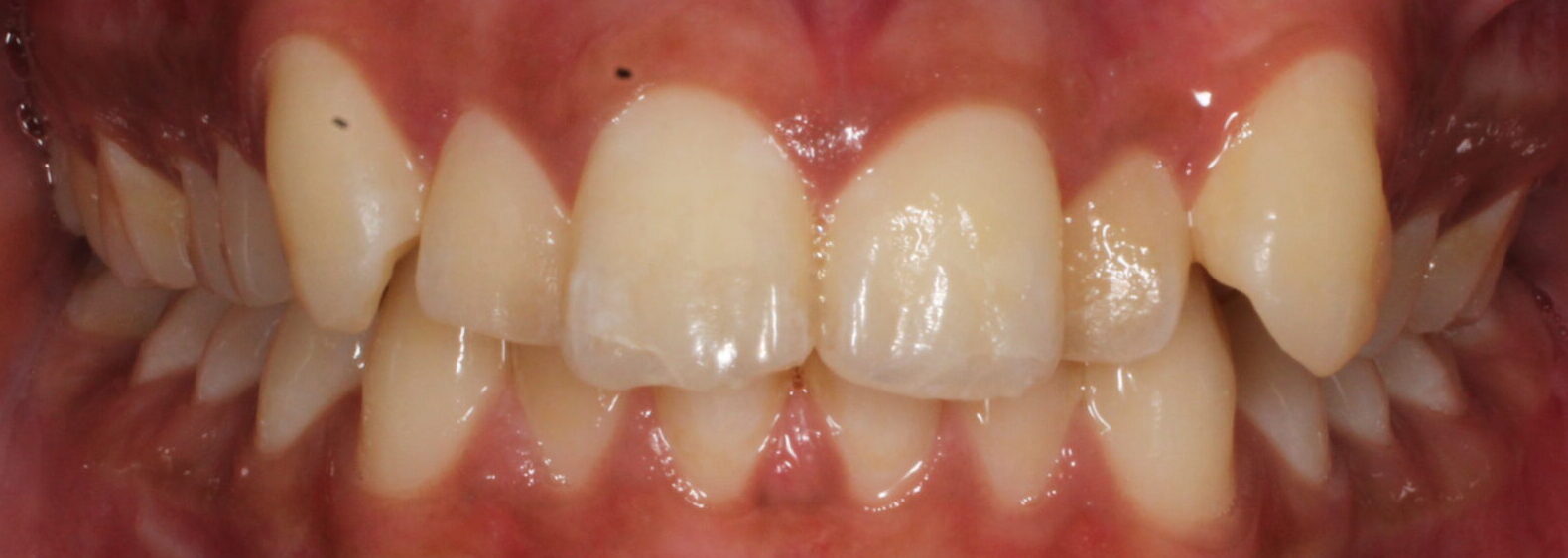 Before braces front teeth