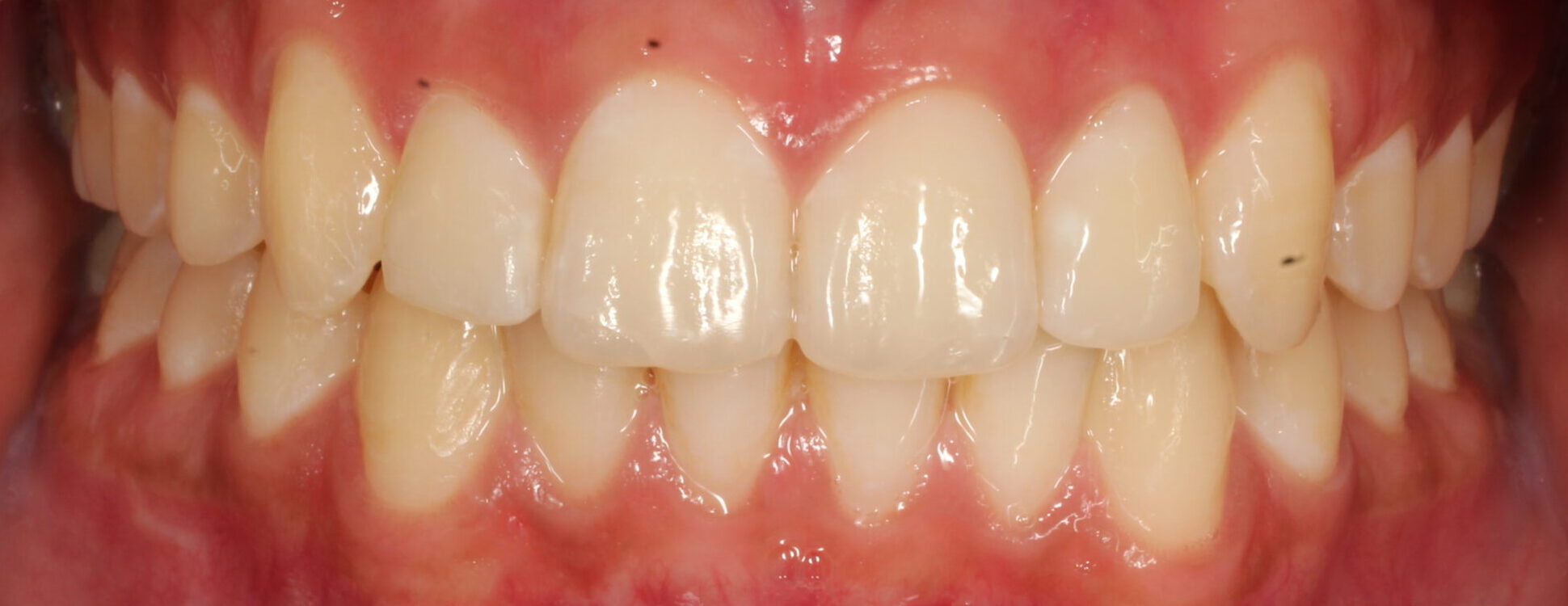After braces front teeth