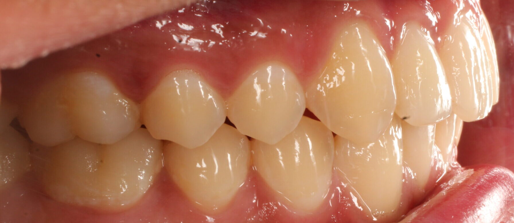 After braces right teeth