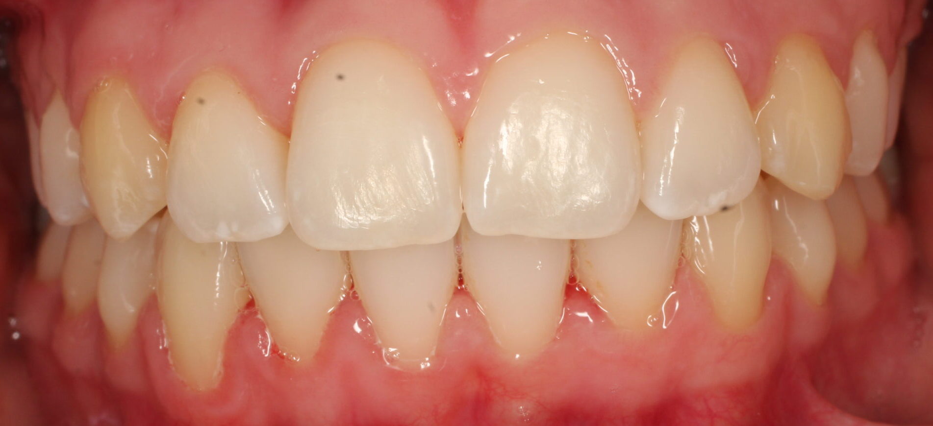 After braces front teeth