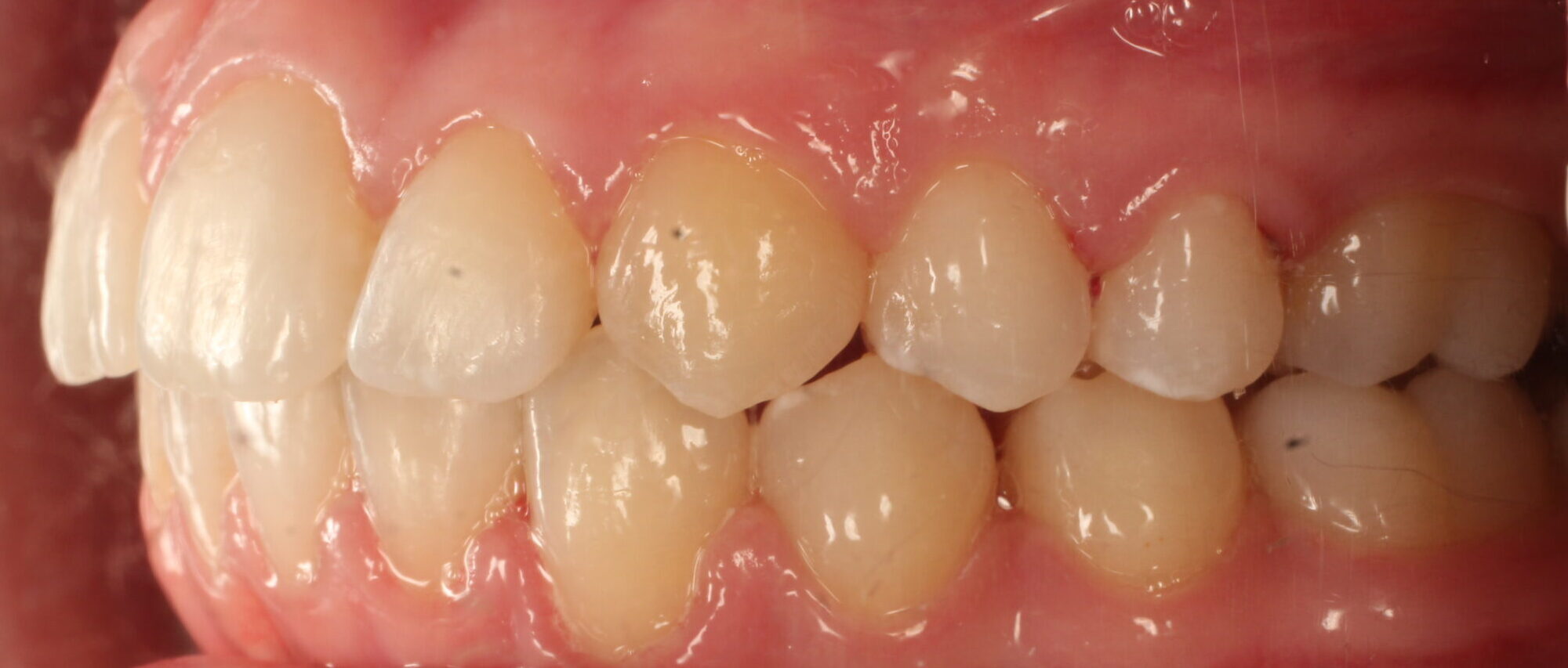 After braces left teeth