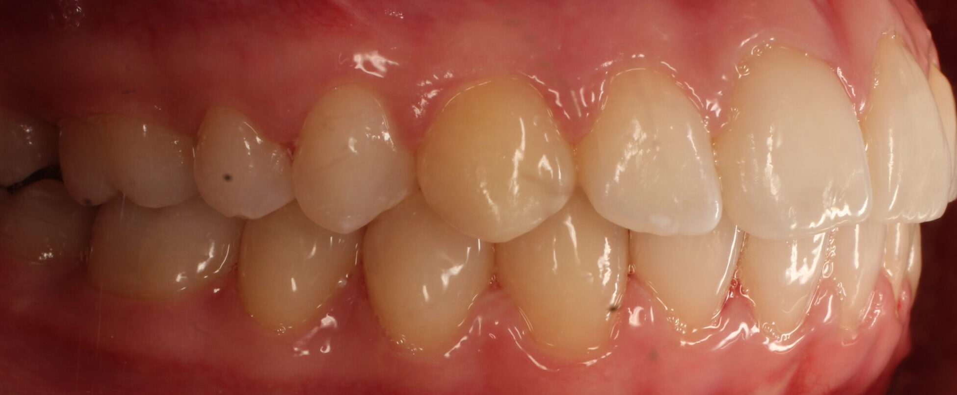 After braces right teeth