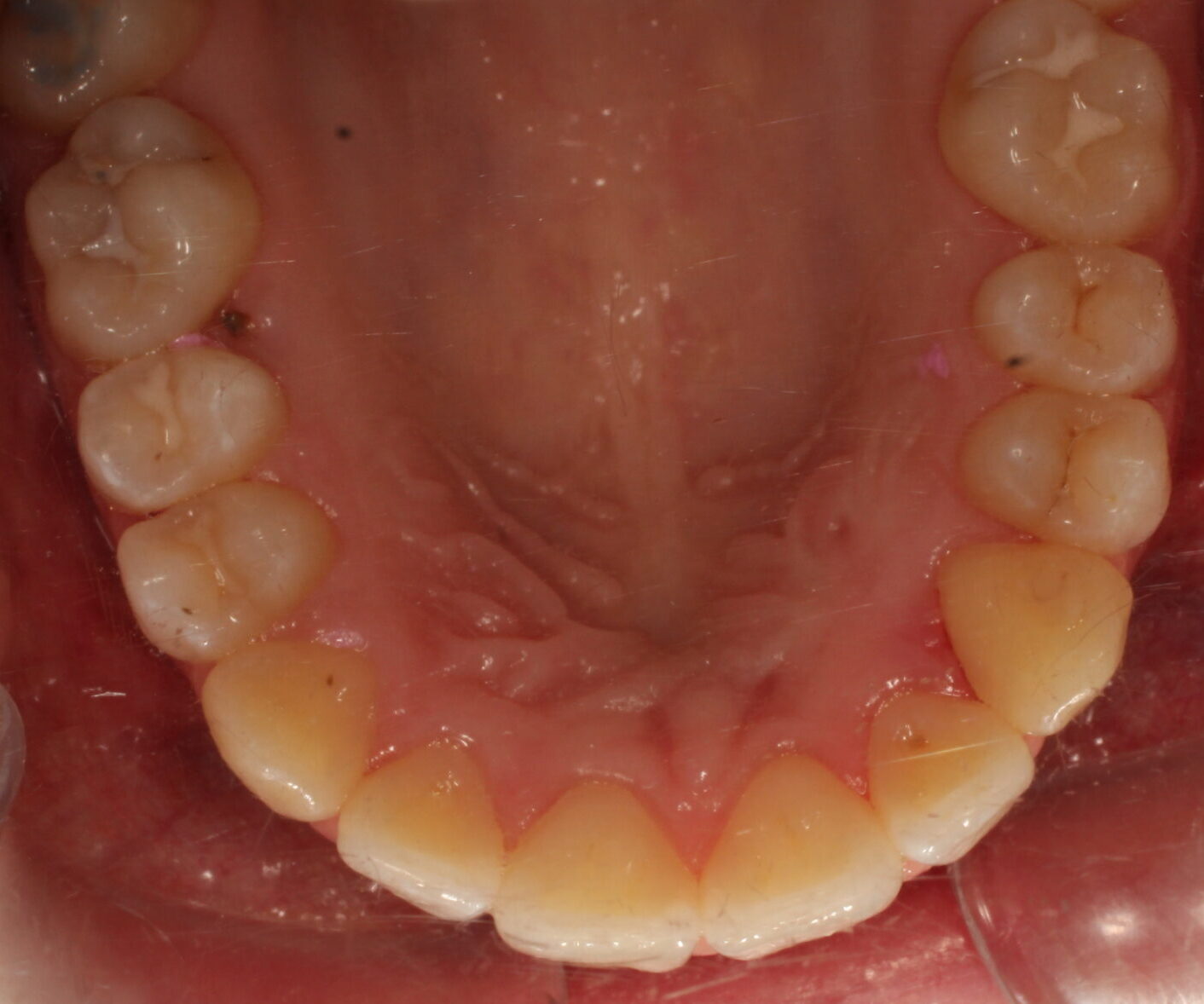 After braces upper teeth