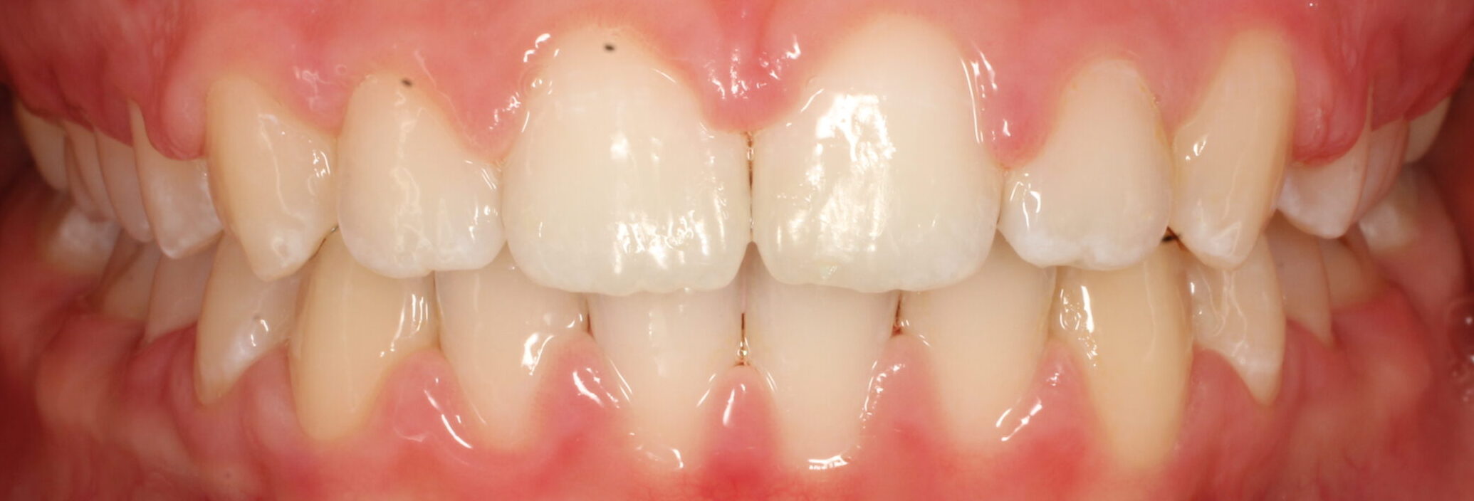 After braces front teeth