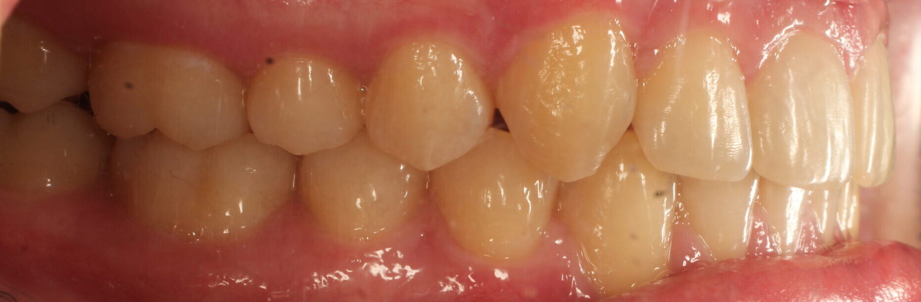 After braces right teeth